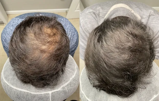Bergen Scalp and Brows