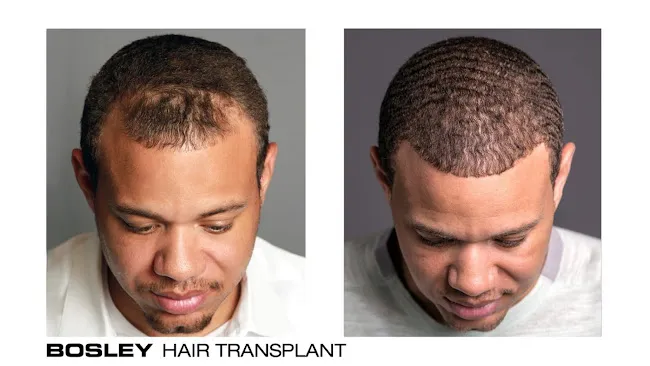 Bosley - Hair Restoration & Transplant - New York