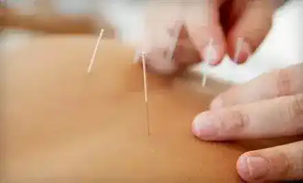 Bronx Acupuncture