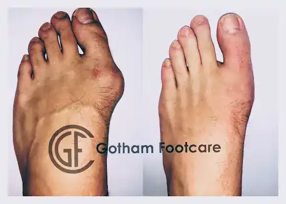 Dr. Miguel Cunha | Morton’s Neuroma Surgery | NYC Podiatrist