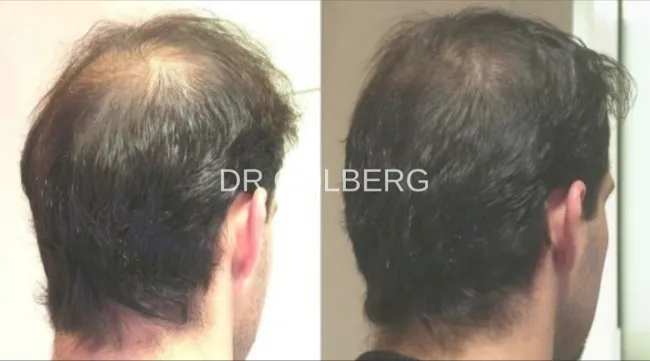 Exosomes Therapy For Hair Loss