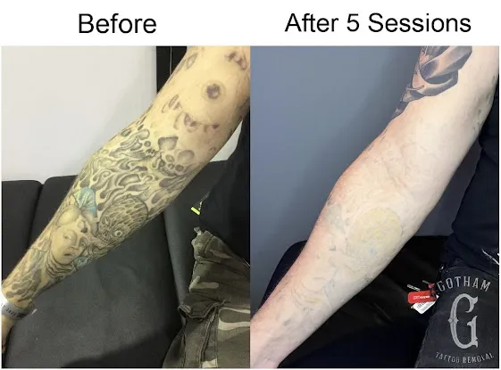 Gotham Tattoo Removal