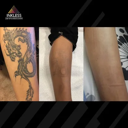 Inkless Tattoo Removal - SoHo (inside Skin Design Tattoos)