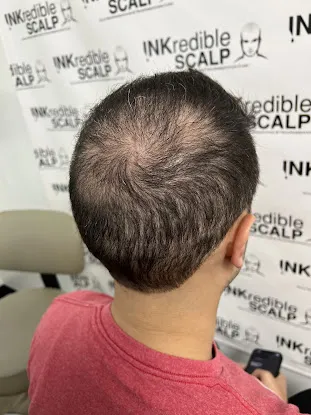 INKredible Scalp Micropigmentation - NYC Office