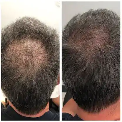John Frank MD Hair Clinics