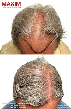 Maxim Hair Restoration & Transplants - New York City