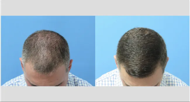 Michael Wolfeld, MD | Wolfeld Hair Restoration New York