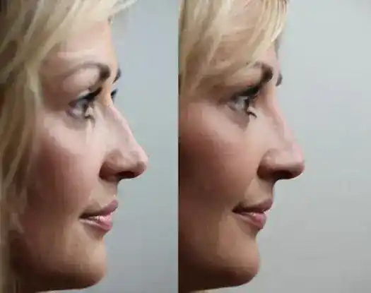 NoseSculpt NYC: Non-Surgical Rhinoplasty Center