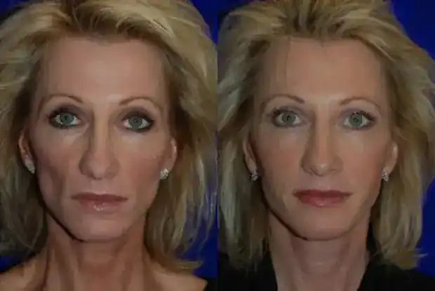 Park Avenue Sculpted Cheek Fillers