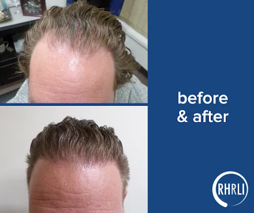 Robotic Hair Restoration of Long Island