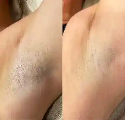 SA Beauty Lab Laser hair removal