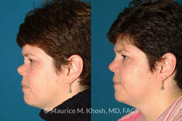 Saddle Nose Repair