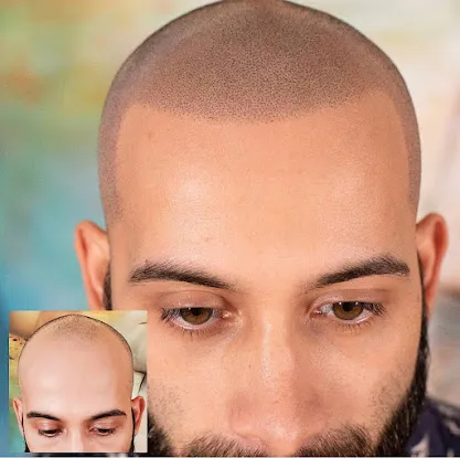 Scalp Micro USA