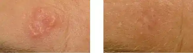 Sebaceous Hyperplasia NYC