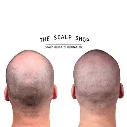 The Scalp Shop | New York Scalp Micropigmentation