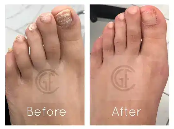 Toe Nail Fungus Treatment