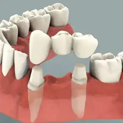 Tooth Implant Brooklyn