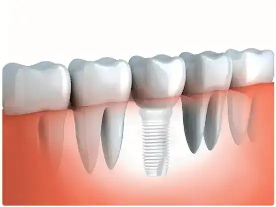 Tooth Implant Dental